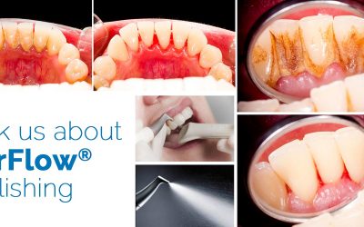 A direct dental hygiene appointment